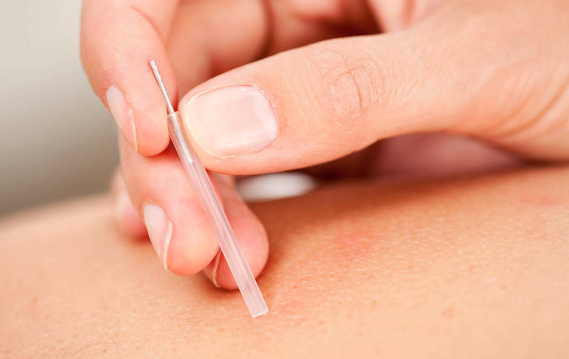 Acupunctuur (binnenkort)