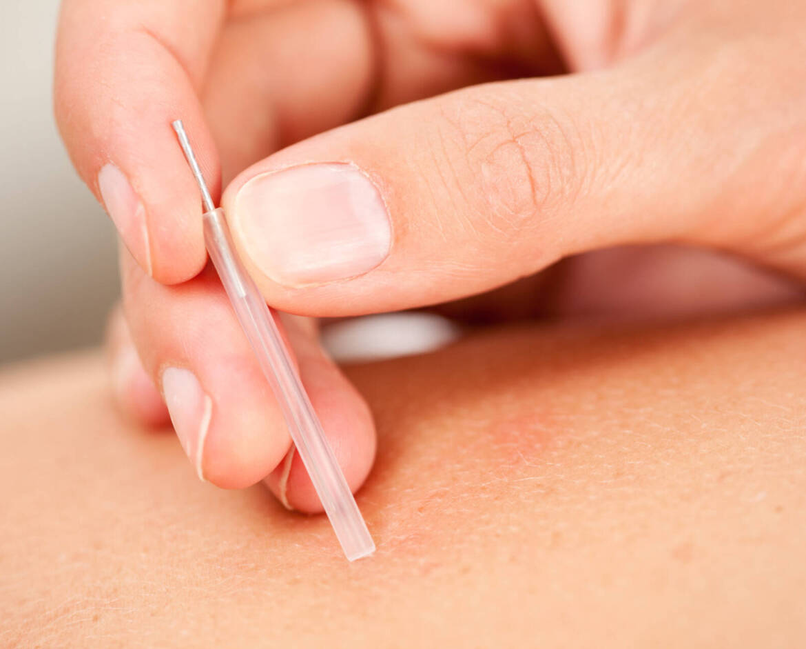 Acupunctuur (binnenkort)